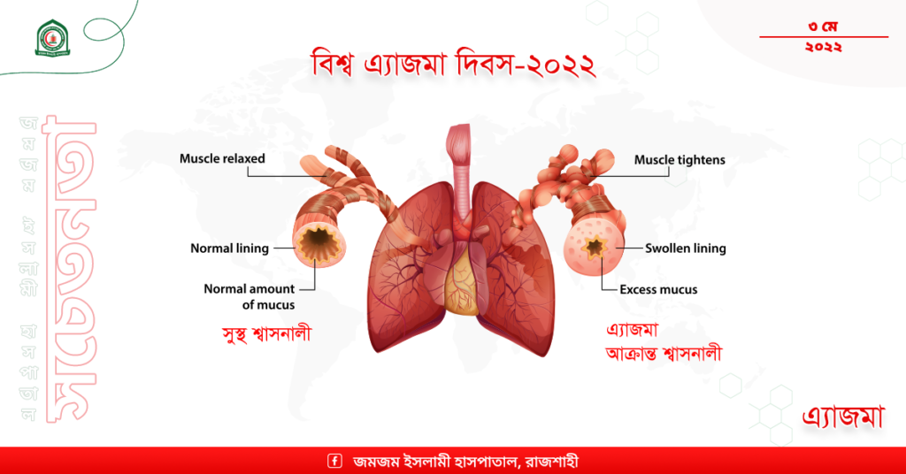 world asthma day ZIHr